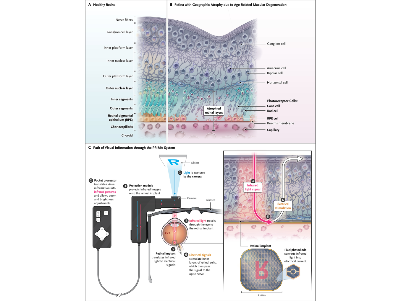 Mechanism of the PRIMA implant
