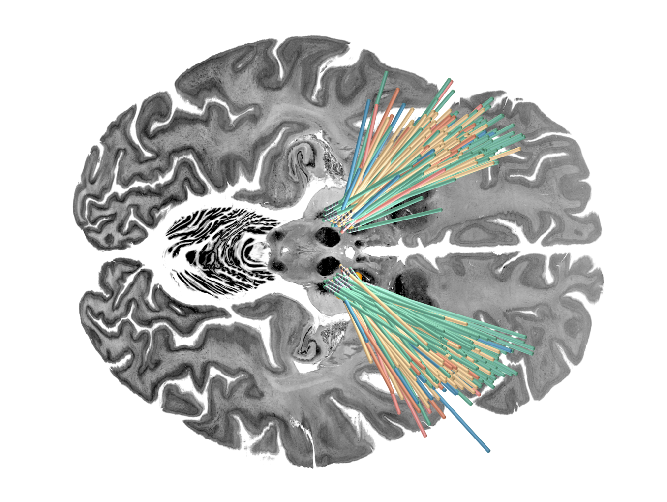 Visualization of DBS leads of the four discovery cohorts investigated.