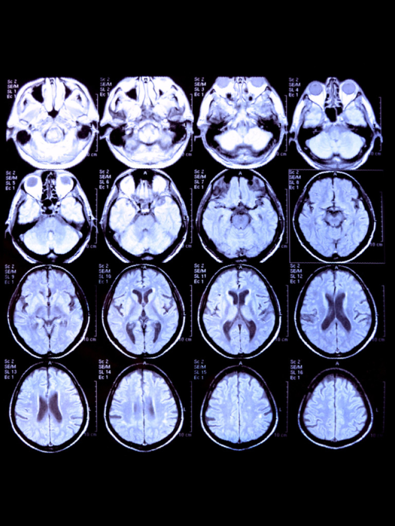 A grid of twenty medical images, likely MRI or CT scans of a brain, displayed against a black background. Each image shows an axial view of the brain, with varying shades of grey, white, and black representing different tissue densities. Some images show visible abnormalities or areas of interest, such as the white X-shaped area in one of the scans. Each image also has small white text labels in the upper left corner.