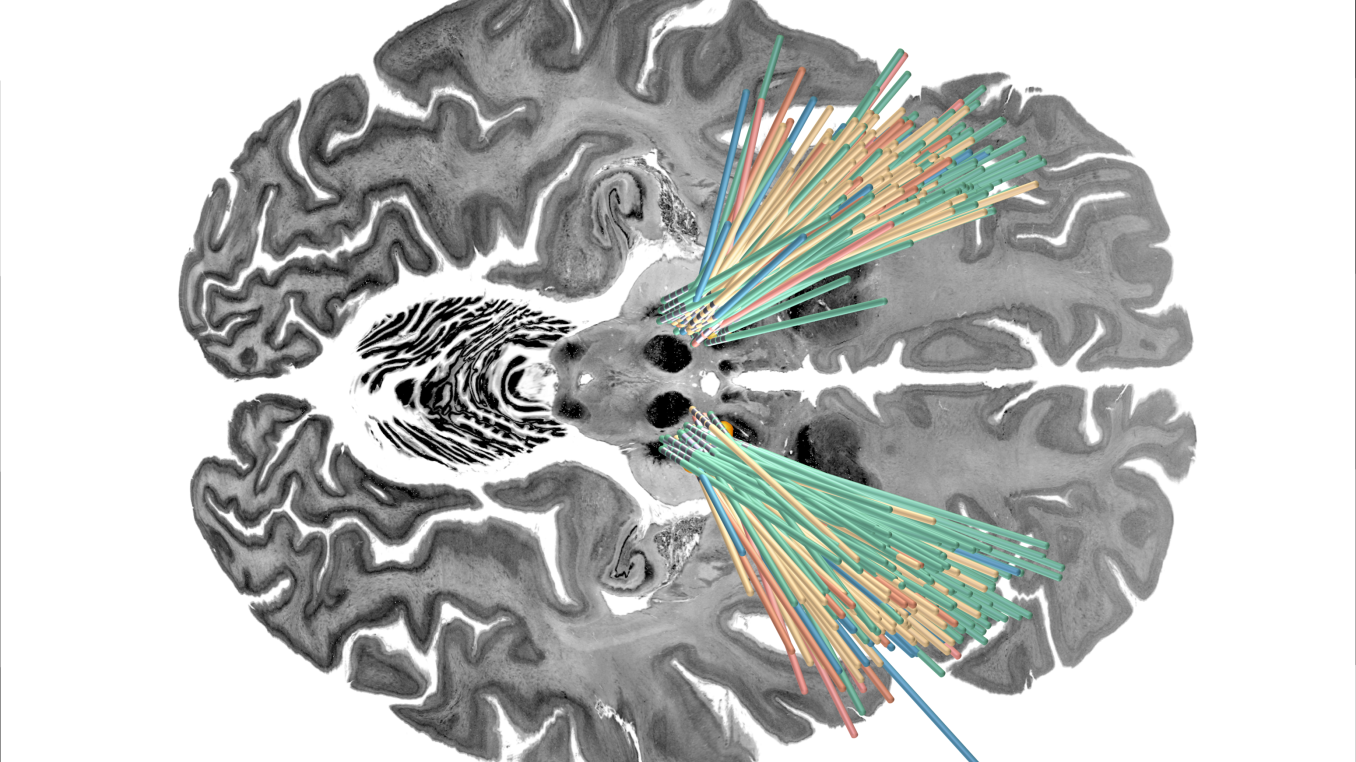 Visualization of DBS leads of the four discovery cohorts investigated.